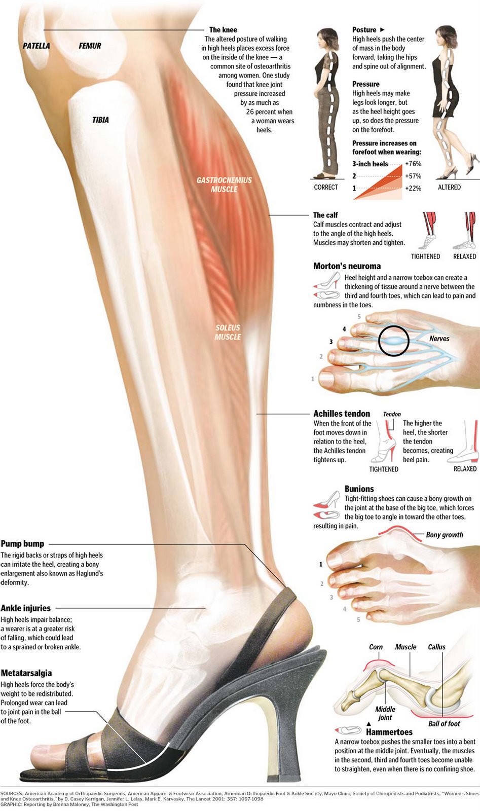 High heels effect on calf muscles
